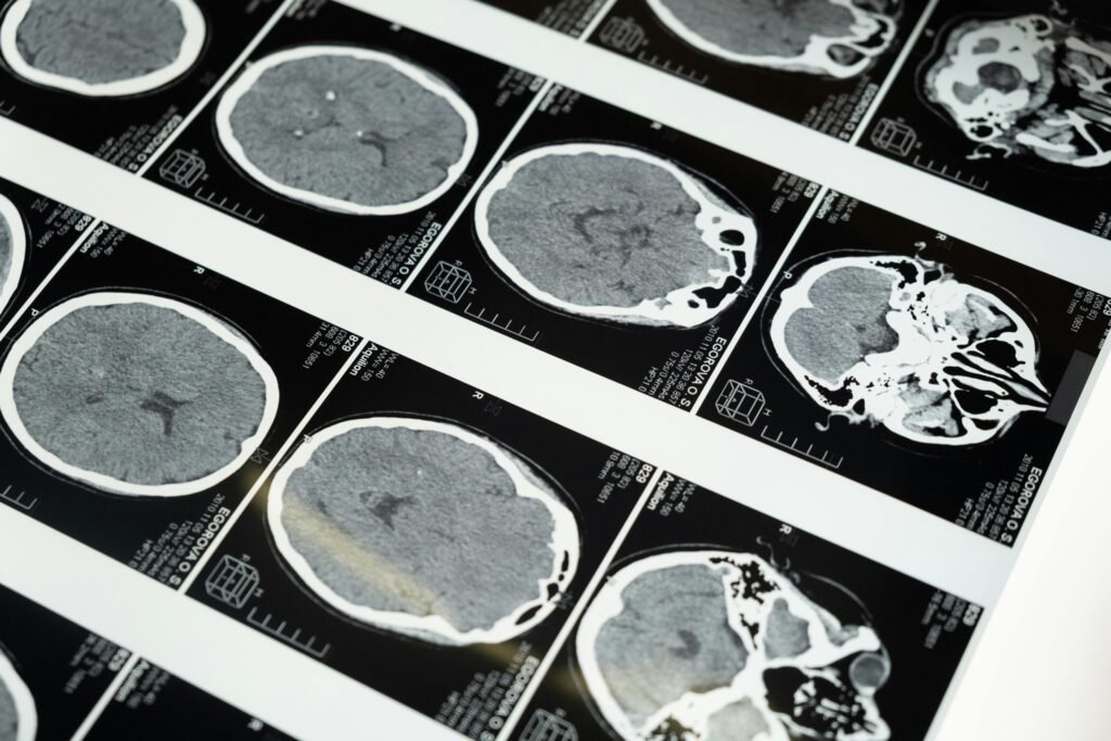 Como a terapia age no cérebro